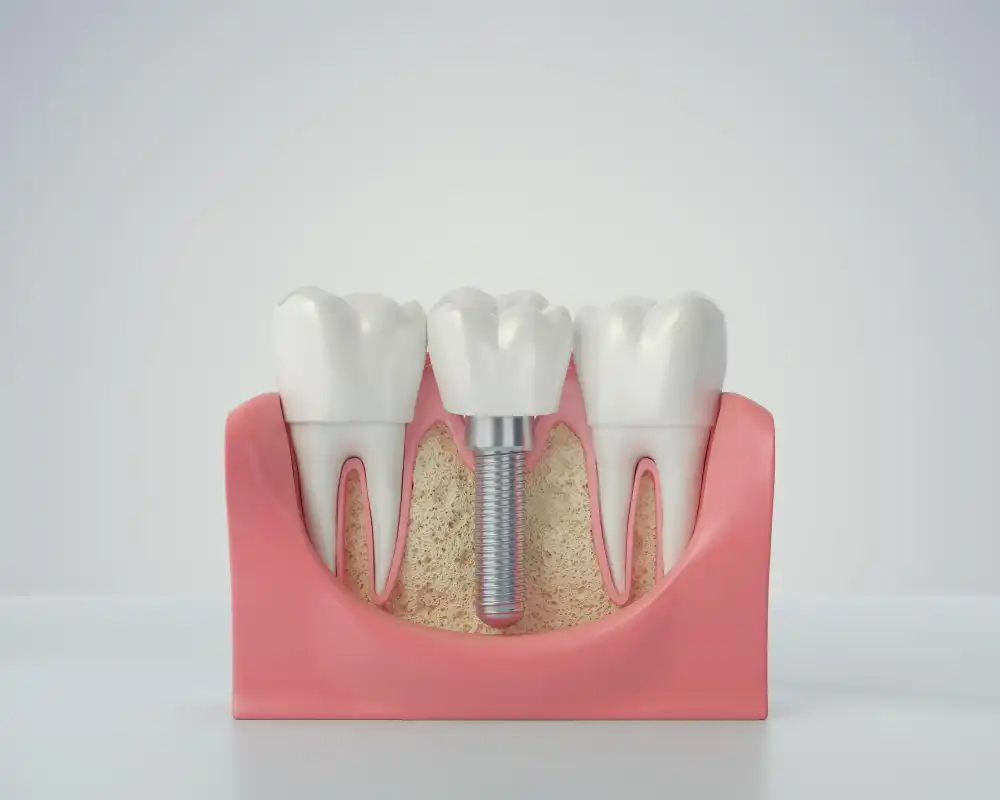 İmplant sonrası şişlik