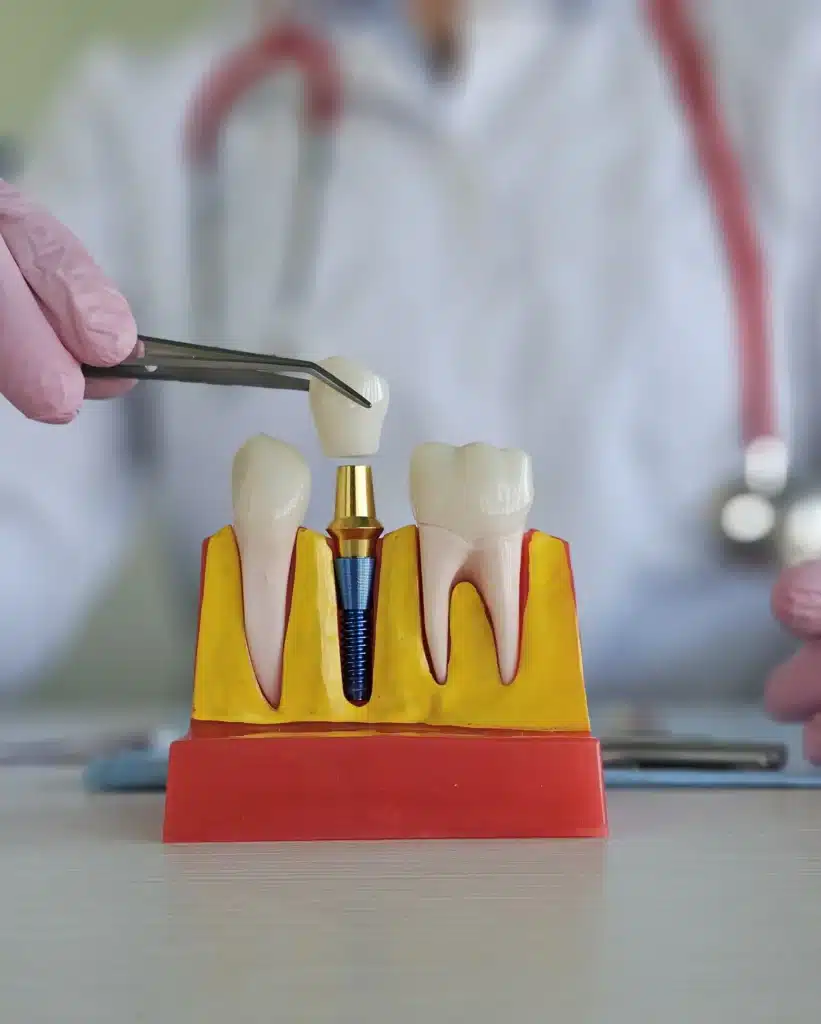 ankara implant fiyatları 